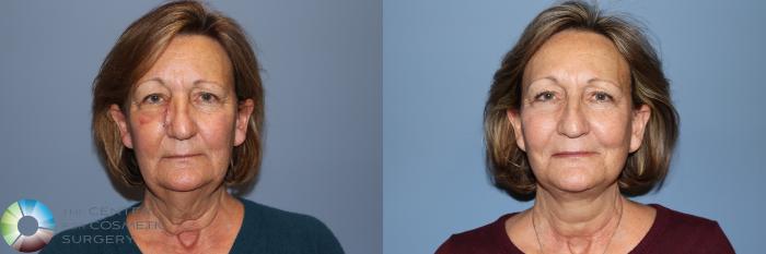 Before & After Mini Facelift Case 11958 Front in Denver and Colorado Springs, CO