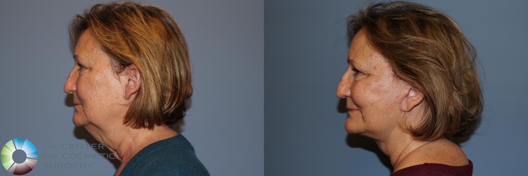 Before & After Mini Facelift Case 11958 Left Side in Denver and Colorado Springs, CO
