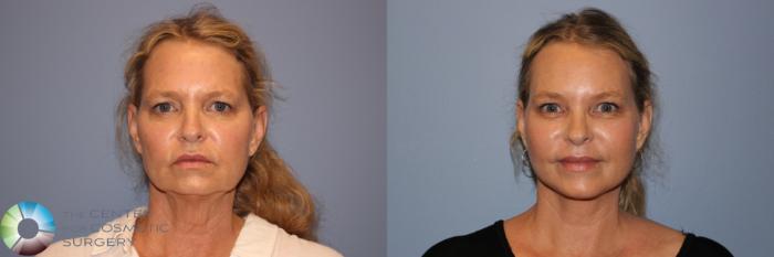 Before & After Mini Facelift Case 11960 Front in Denver and Colorado Springs, CO