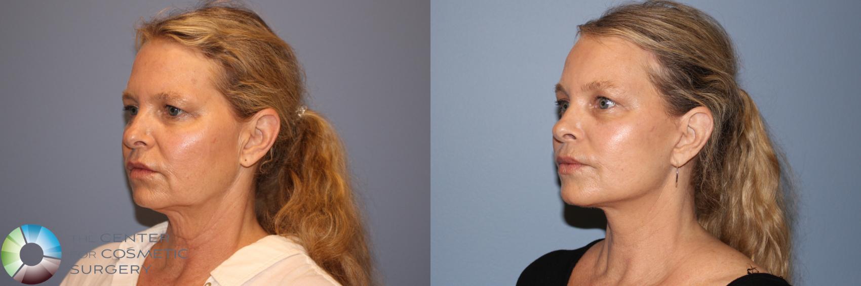 Before & After Mini Facelift Case 11960 Left Oblique in Denver and Colorado Springs, CO