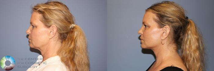 Before & After Mini Facelift Case 11960 Left Side in Denver and Colorado Springs, CO