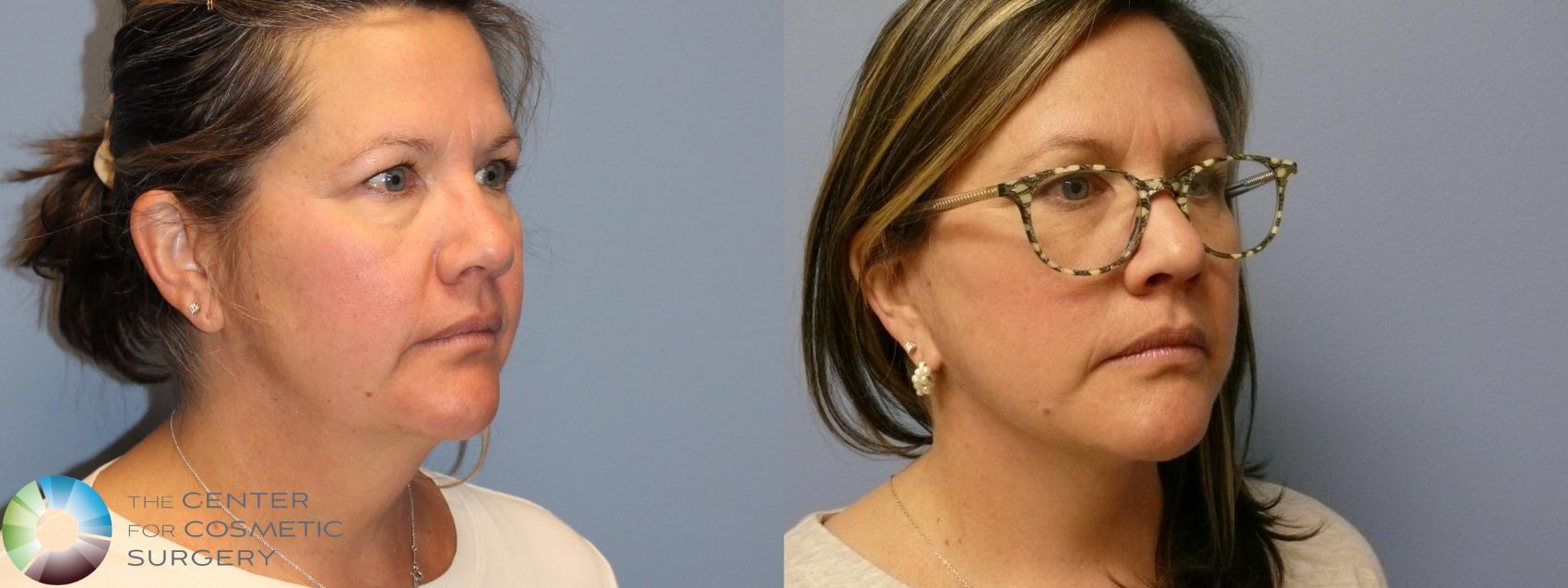 Before & After Mini Facelift Case 11986 Right Oblique in Denver and Colorado Springs, CO