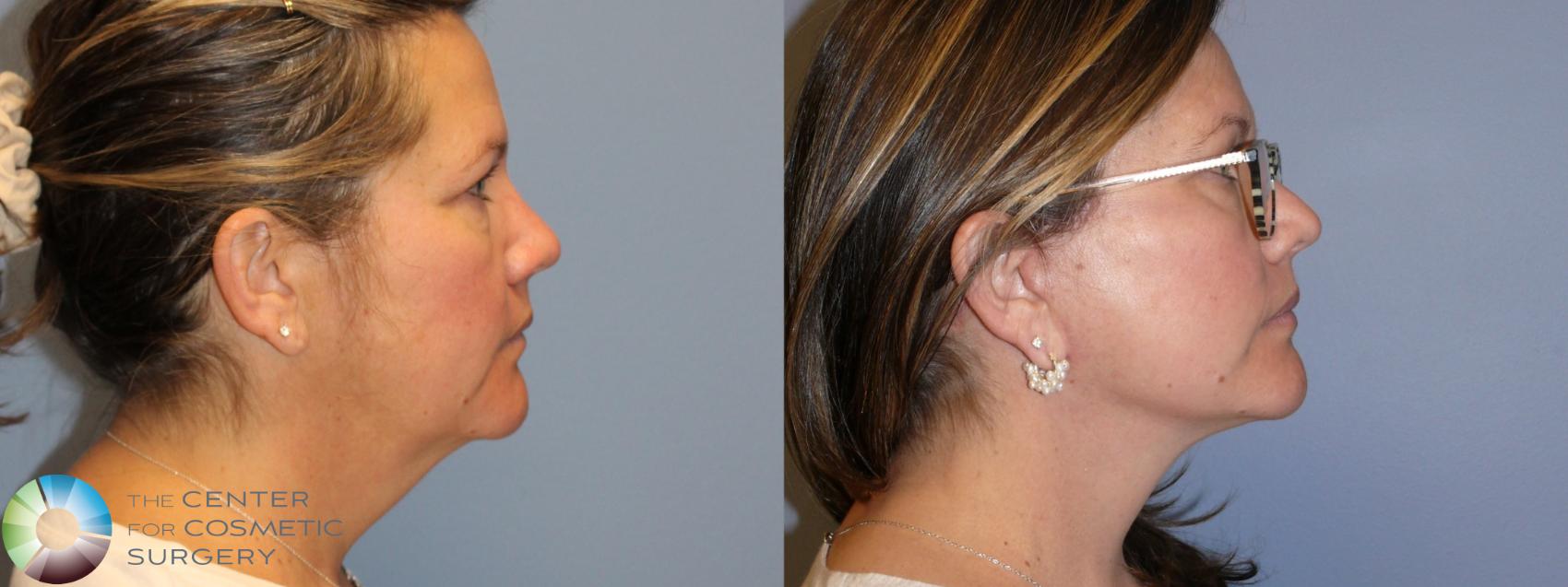 Before & After Mini Facelift Case 11986 Right Side in Denver and Colorado Springs, CO