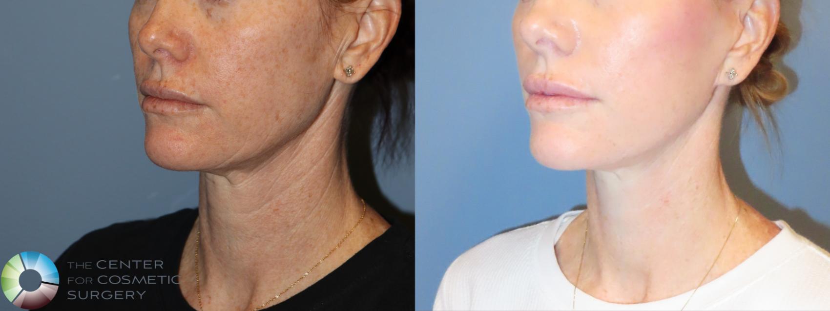 Before & After Mini Facelift Case 11990 Left Oblique in Denver and Colorado Springs, CO