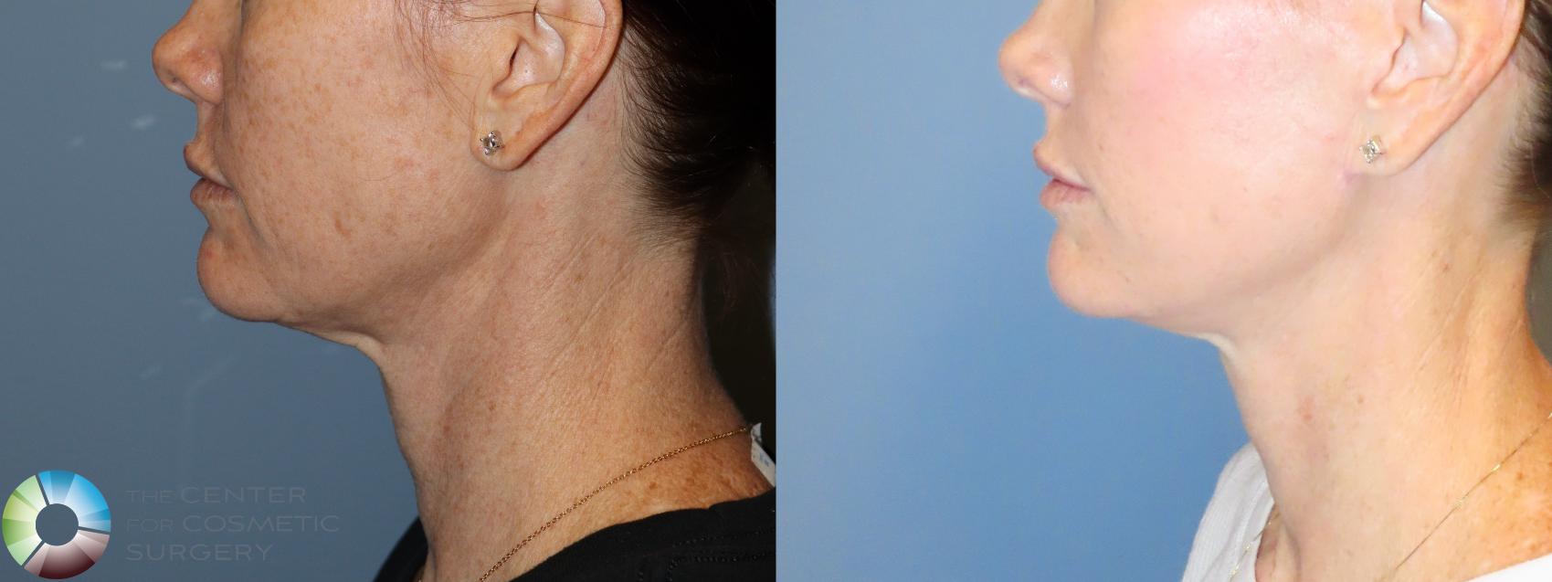 Before & After Mini Facelift Case 11990 Left Side in Denver and Colorado Springs, CO
