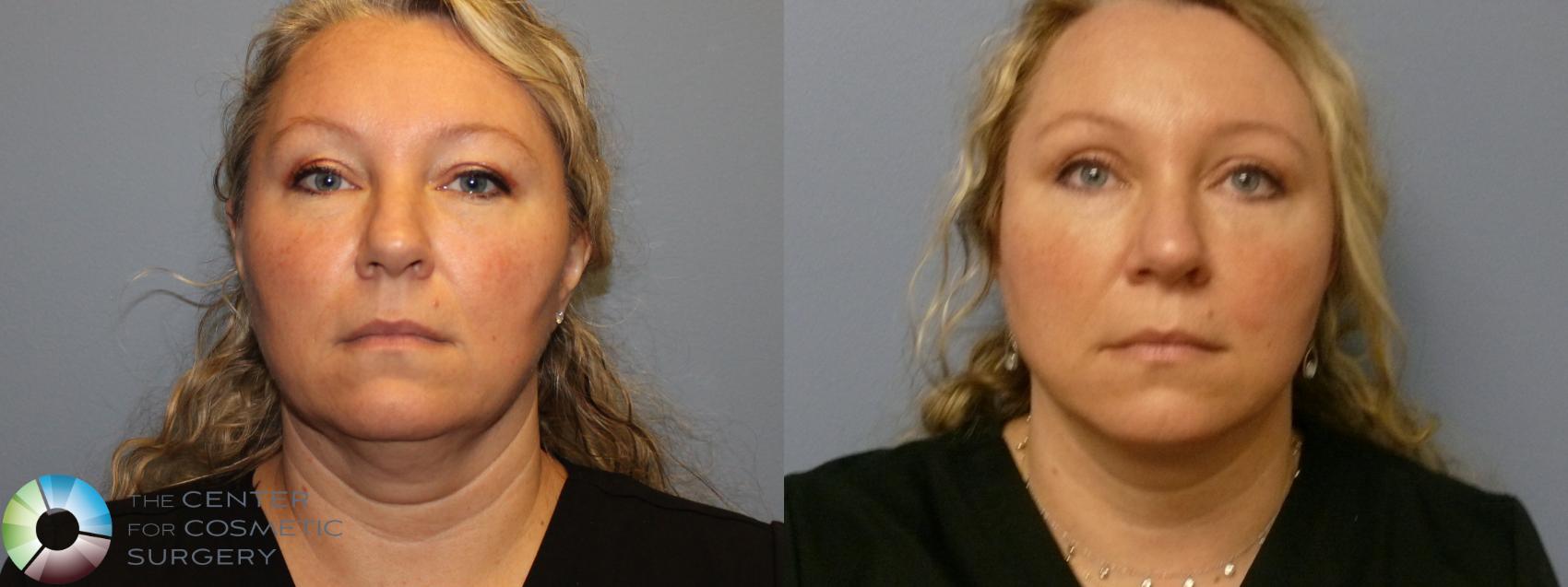 Before & After Mini Facelift Case 11994 Front in Denver and Colorado Springs, CO