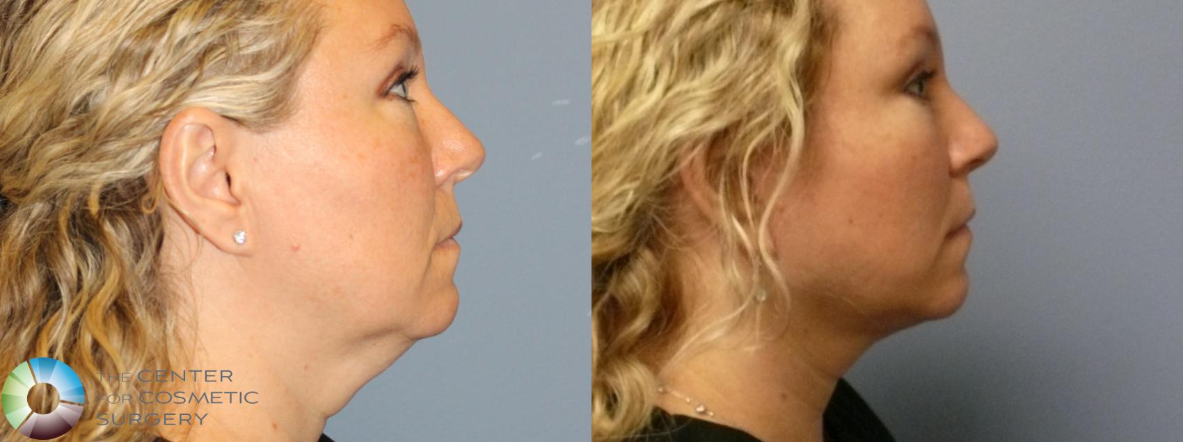 Before & After Mini Facelift Case 11994 Right Side in Denver and Colorado Springs, CO