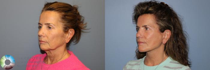 Before & After Mini Facelift Case 12000 Left Oblique in Denver and Colorado Springs, CO