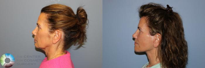 Before & After Mini Facelift Case 12000 Left Side in Denver and Colorado Springs, CO