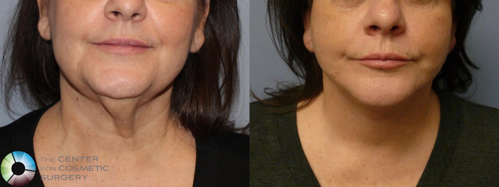 Best Denver Mini-Facelift/Neck Lift