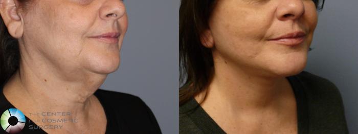 Best Denver Mini-Facelift/Neck Lift