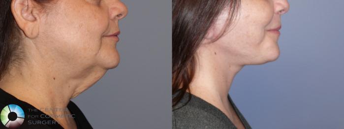 Best Denver Mini-Facelift/Neck Lift