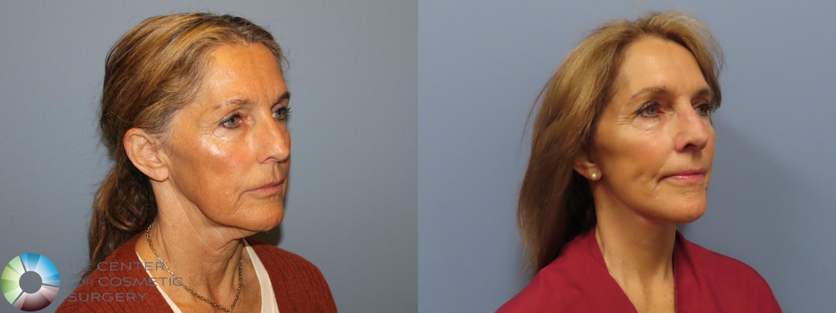 Before & After Mini Facelift Case 12017 Right Oblique in Denver and Colorado Springs, CO