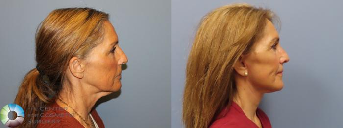 Before & After Mini Facelift Case 12017 Right Side in Denver and Colorado Springs, CO