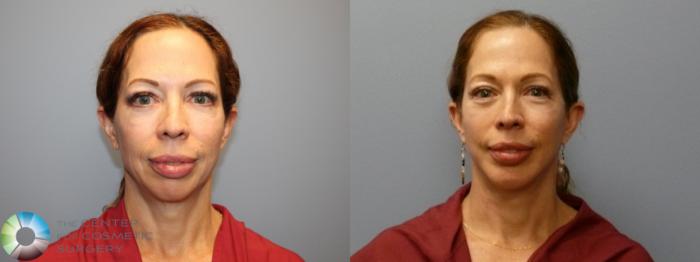 Before & After Mini Facelift Case 12080 Front in Denver and Colorado Springs, CO