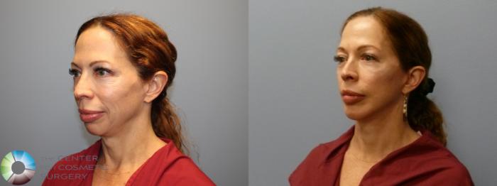 Before & After Mini Facelift Case 12080 Left Oblique in Denver and Colorado Springs, CO