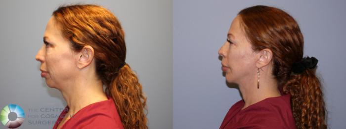 Before & After Mini Facelift Case 12080 Left Side in Denver and Colorado Springs, CO