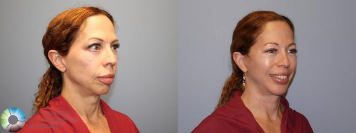 Before & After Mini Facelift Case 12080 Right Oblique in Denver and Colorado Springs, CO