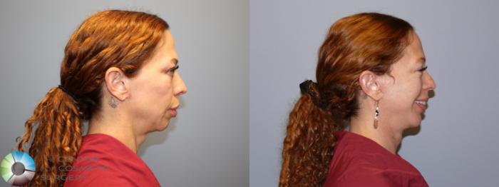 Before & After Mini Facelift Case 12080 Right Side in Denver and Colorado Springs, CO