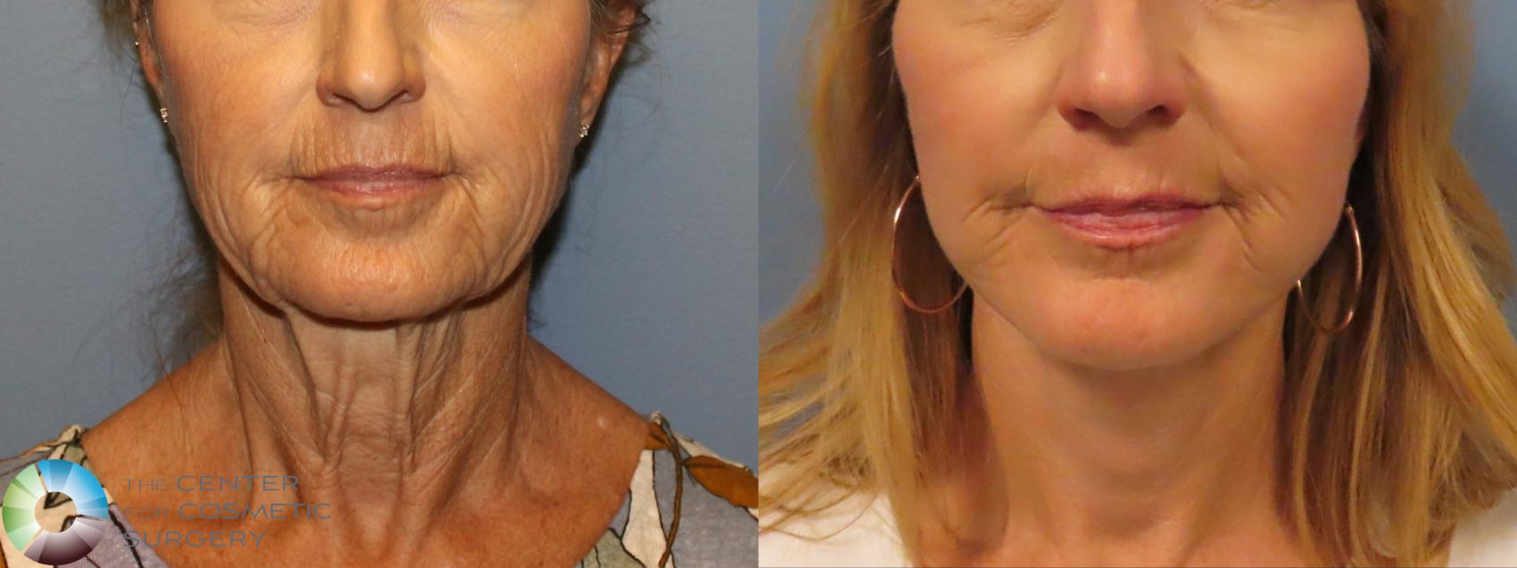 Before & After Mini Facelift Case 12088 Front in Denver and Colorado Springs, CO