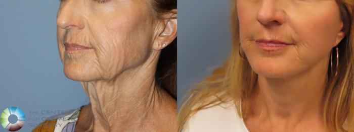 Best Denver Mini-Facelift/Neck Lift