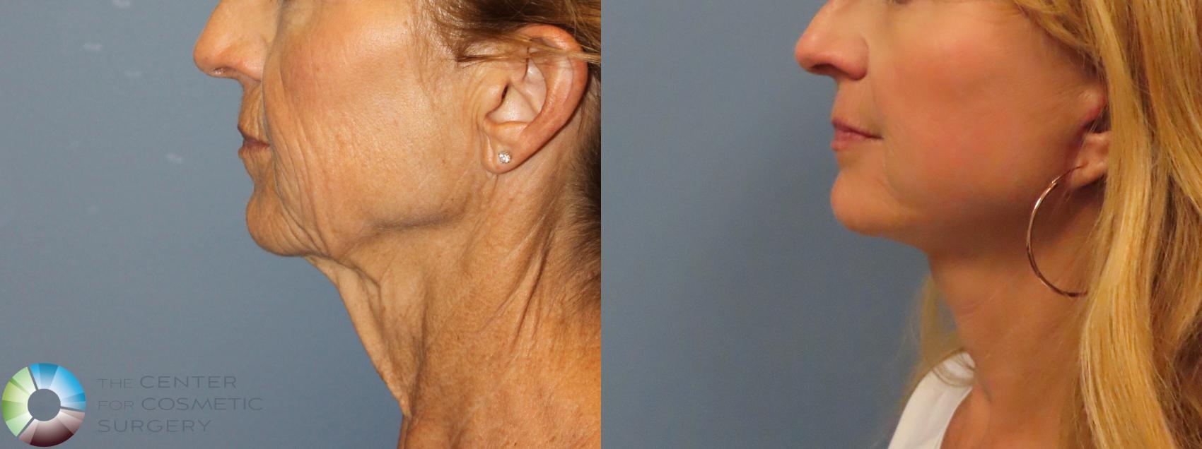 Best Denver Mini-Facelift/Neck Lift