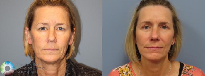 Best Denver Mini-Facelift/Neck Lift