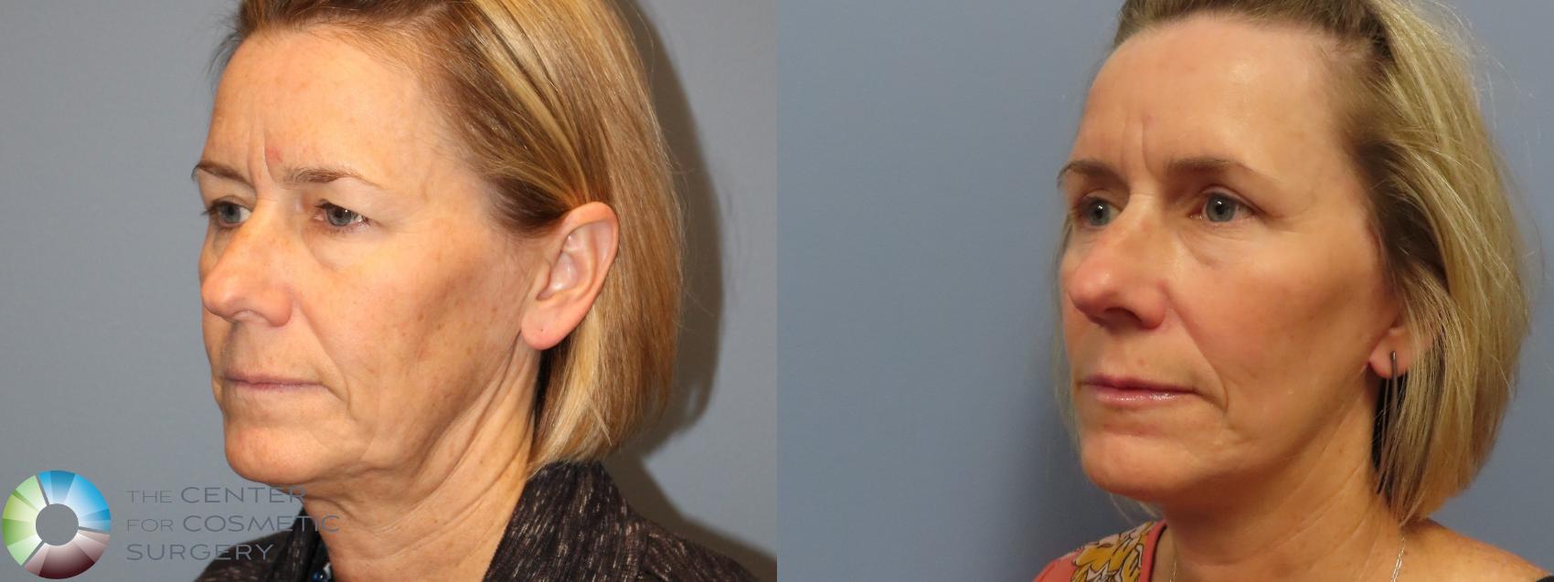 Before & After Mini Facelift Case 12089 Left Oblique in Denver and Colorado Springs, CO