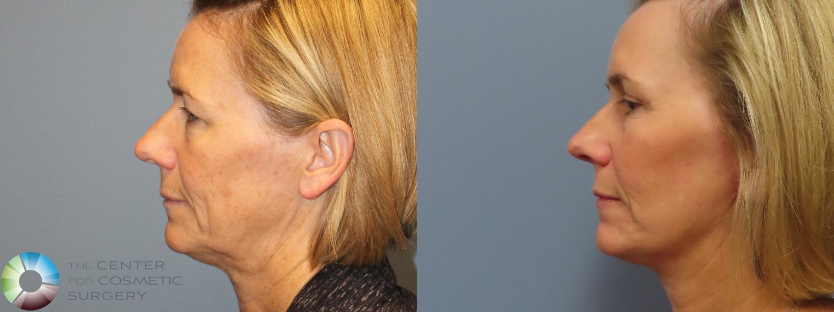 Before & After Mini Facelift Case 12089 Left Side in Denver and Colorado Springs, CO