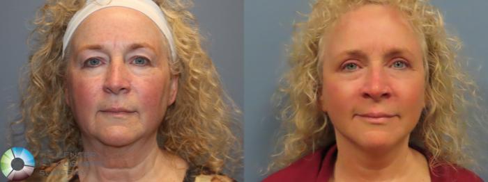 Best Denver Mini-Facelift/Neck Lift