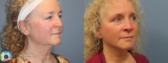 Best Denver Mini-Facelift/Neck Lift