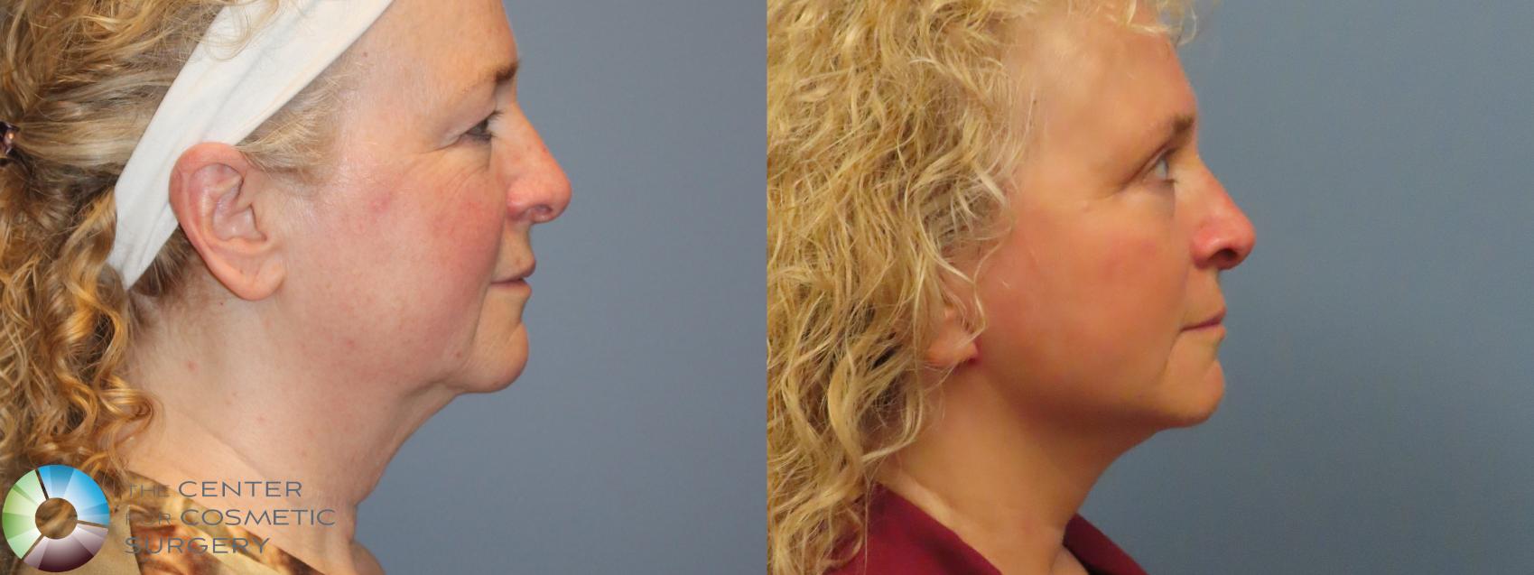 Before & After Mini Facelift Case 12091 Right Side in Denver and Colorado Springs, CO