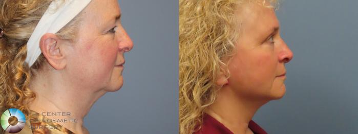 Best Denver Mini-Facelift/Neck Lift