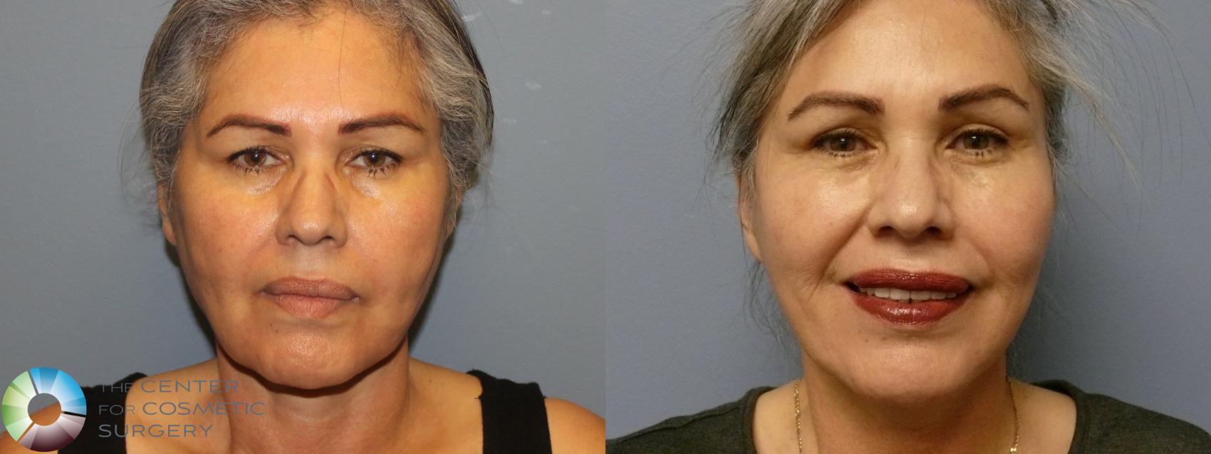 Before & After Mini Facelift Case 12096 Front in Denver and Colorado Springs, CO