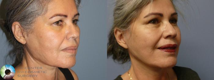 Best Denver Mini-Facelift/Neck Lift