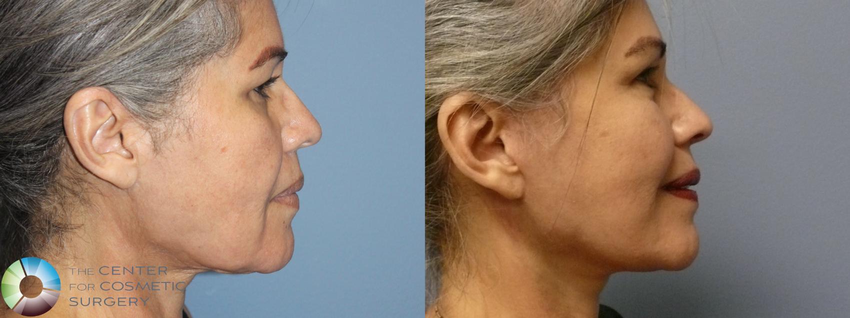 Before & After Mini Facelift Case 12096 Right Side in Denver and Colorado Springs, CO