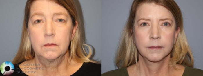 Best Denver Mini-Facelift/Neck Lift