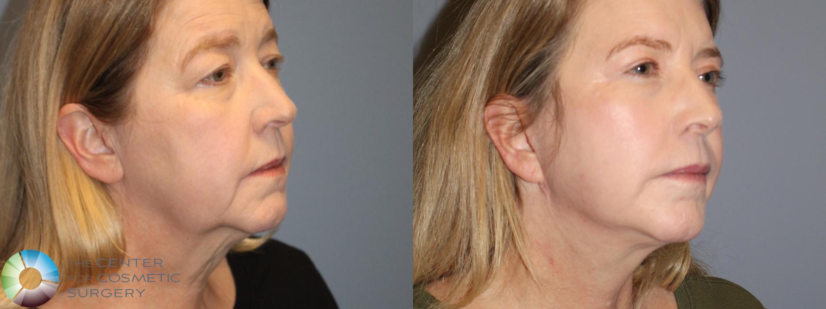 Before & After Mini Facelift Case 12100 Right Oblique in Denver and Colorado Springs, CO