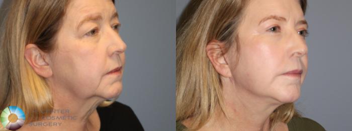 Best Denver Mini-Facelift/Neck Lift