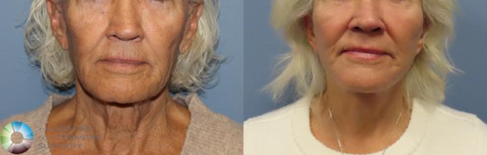 Best Denver Mini-Facelift/Neck Lift