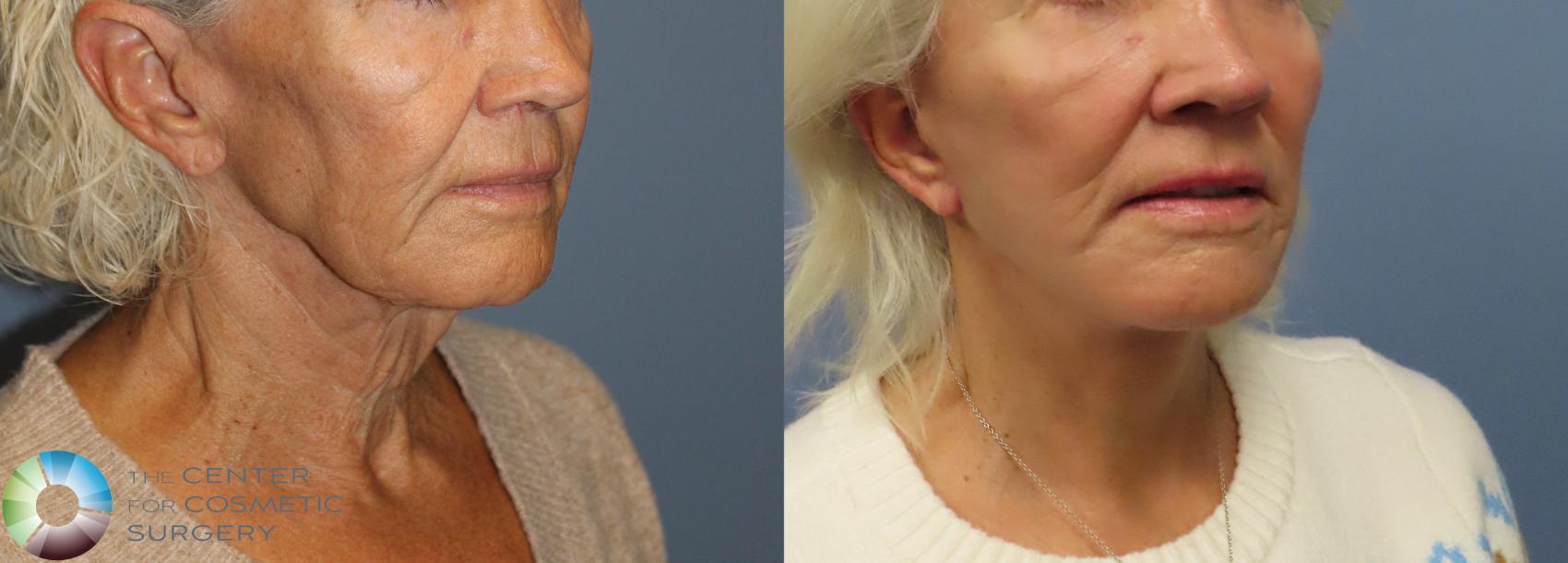 Before & After Mini Facelift Case 12101 Right Oblique in Denver and Colorado Springs, CO
