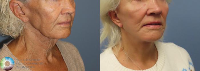 Best Denver Mini-Facelift/Neck Lift