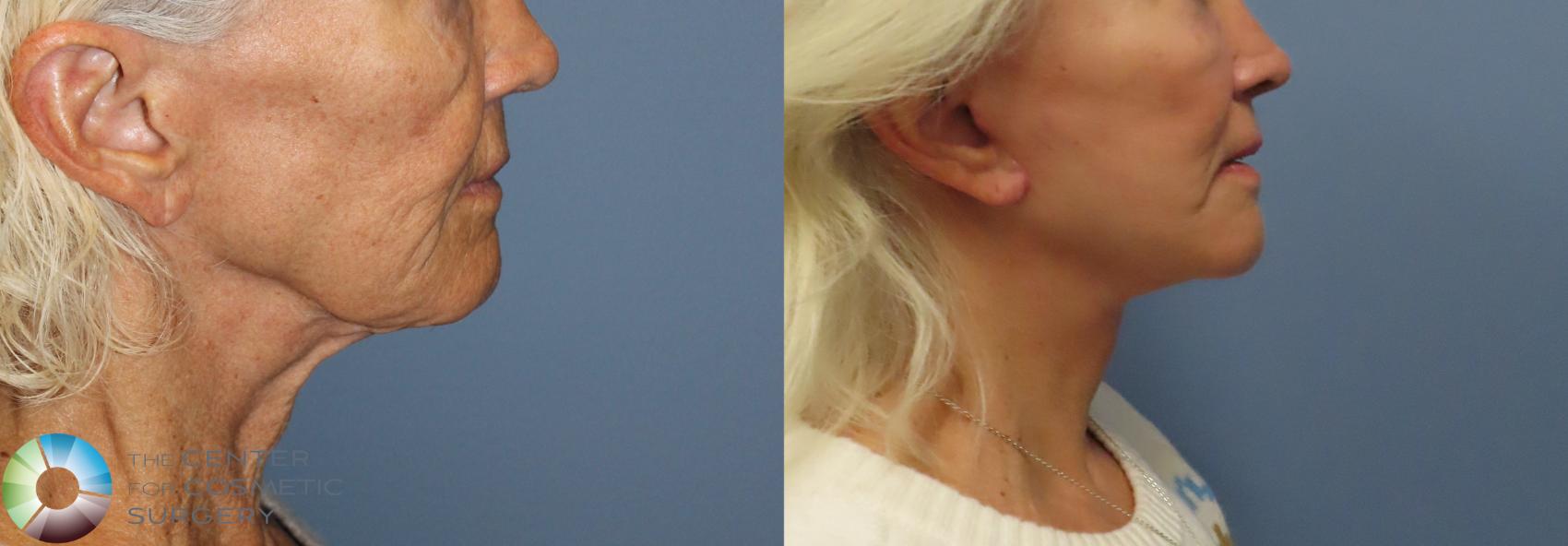 Before & After Mini Facelift Case 12101 Right Side in Denver and Colorado Springs, CO