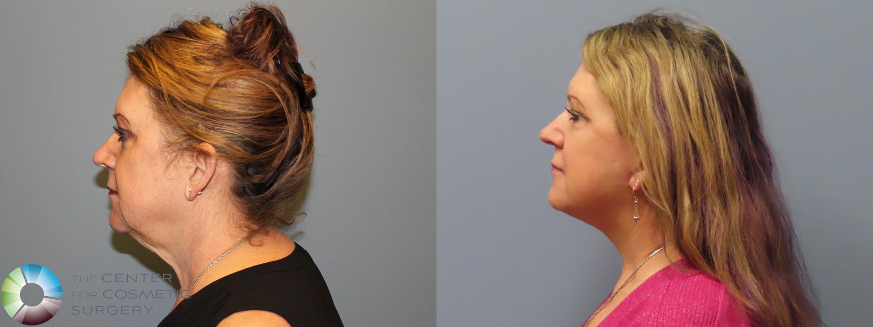Before & After Mini Facelift Case 12111 Left Side in Denver and Colorado Springs, CO