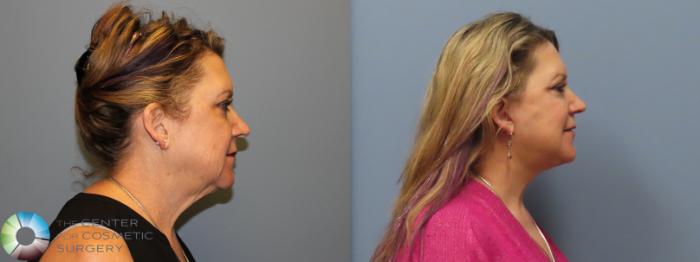 Before & After Mini Facelift Case 12111 Right Side in Denver and Colorado Springs, CO