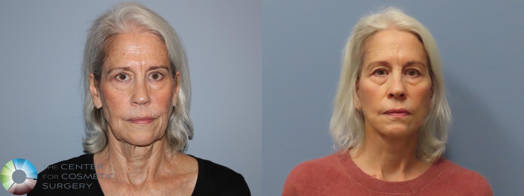 Before & After Mini Facelift Case 12112 Front in Denver and Colorado Springs, CO