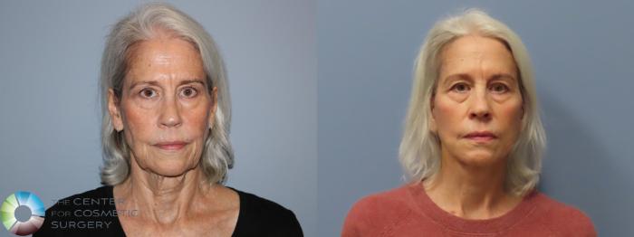 Before & After Neck Lift Case 12112 Front in Denver and Colorado Springs, CO