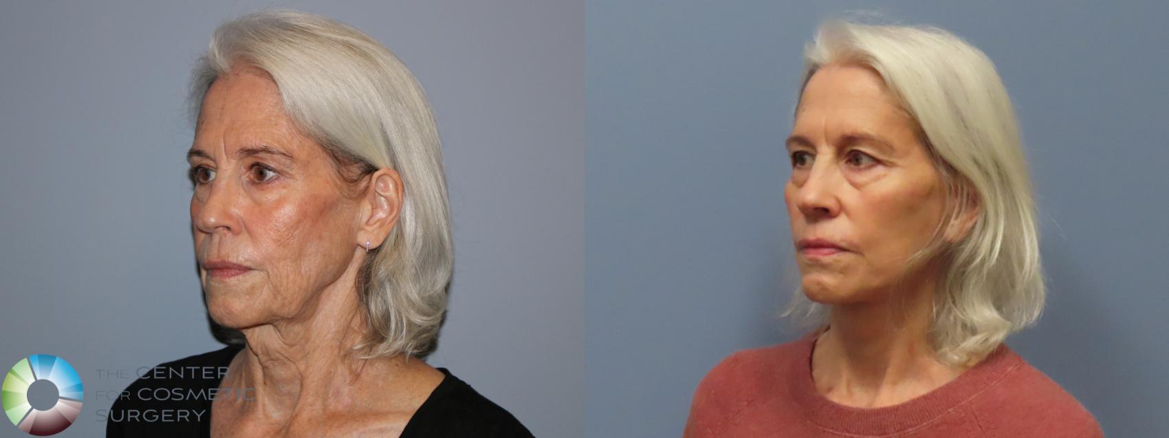 Before & After Mini Facelift Case 12112 Left Oblique in Denver and Colorado Springs, CO
