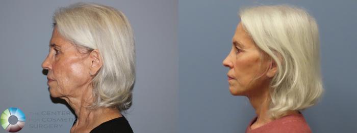 Before & After Mini Facelift Case 12112 Left Side in Denver and Colorado Springs, CO