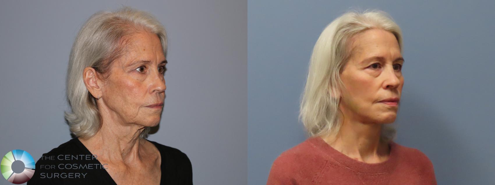 Before & After Mini Facelift Case 12112 Right Oblique in Denver and Colorado Springs, CO